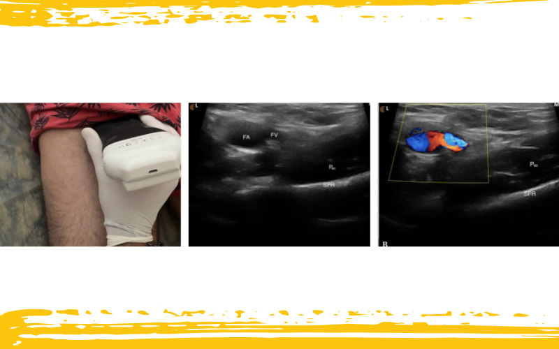 Musculo pectineo ecografia 2.jpg